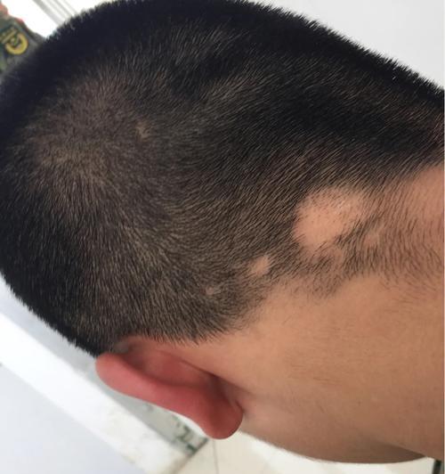 美颜相机斑秃如何恢复？操作步骤是什么？