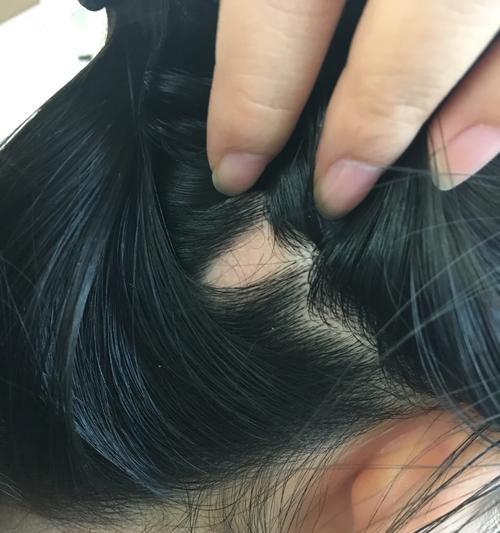 美颜相机斑秃如何恢复？操作步骤是什么？